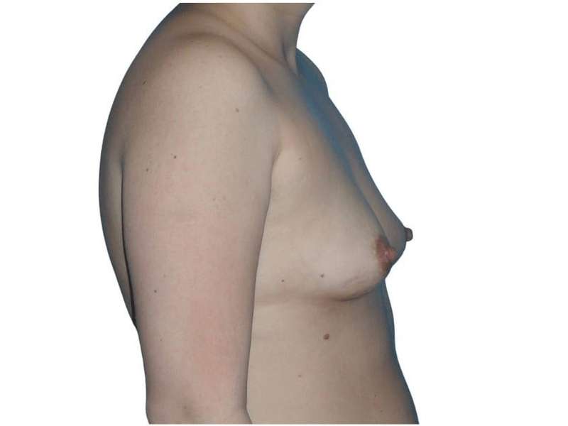 Breast Augmentation Before & After Patient #721