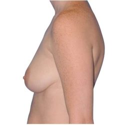 Breast Augmentation Before & After Patient #733