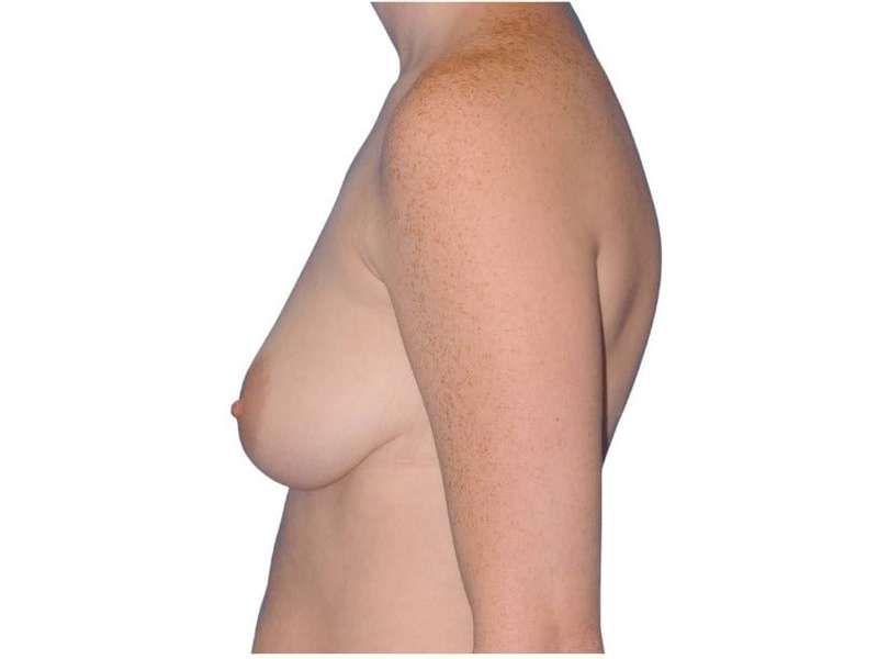 Breast Augmentation Before & After Patient #733