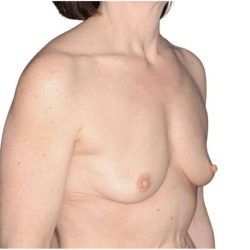 Breast Augmentation Before & After Patient #740