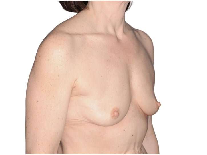 Breast Augmentation Before & After Patient #740