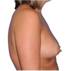 Breast Augmentation Before & After Patient #747