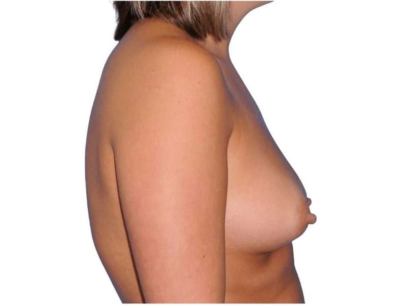 Breast Augmentation Before & After Patient #747