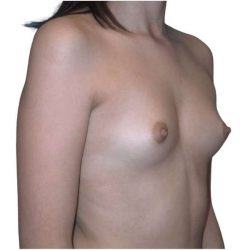 Breast Augmentation Before & After Patient #754