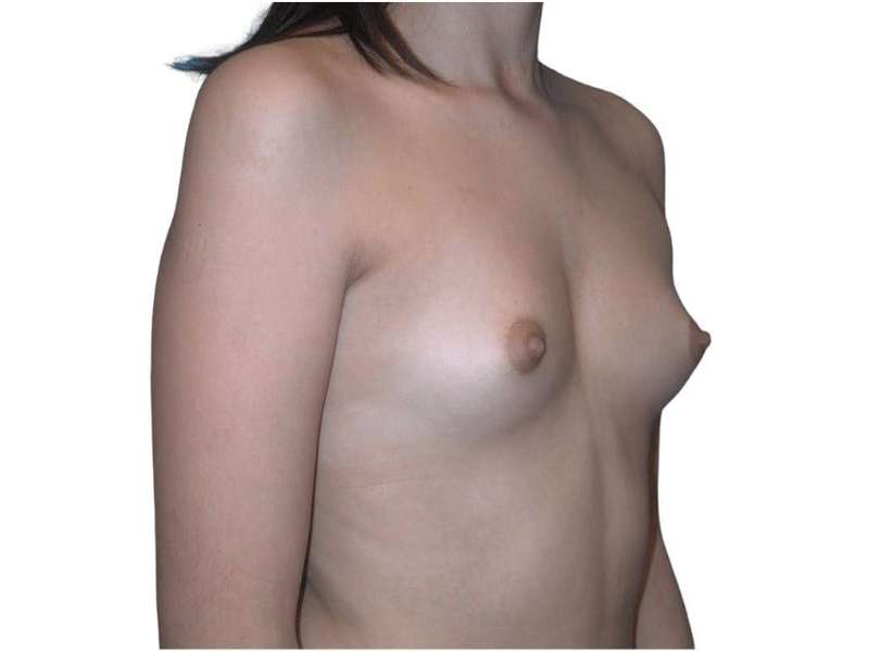 Breast Augmentation Before & After Patient #754