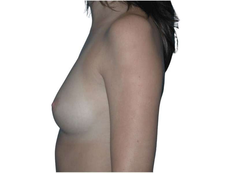 Breast Augmentation Before & After Patient #761