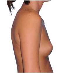 Breast Augmentation Before & After Patient #768