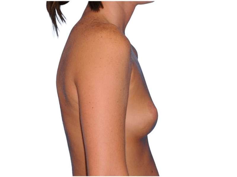 Breast Augmentation Before & After Patient #768