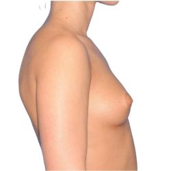 Breast Augmentation Before & After Patient #775