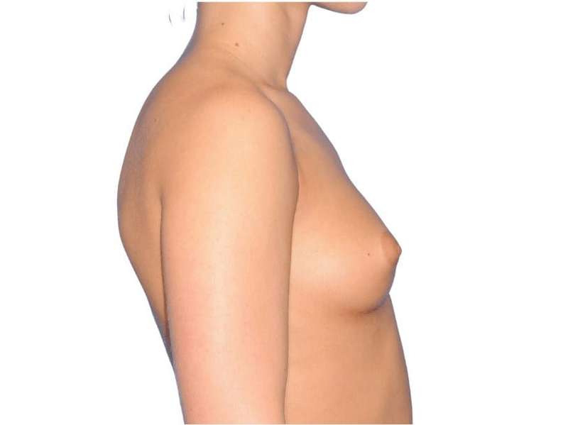 Breast Augmentation Before & After Patient #775
