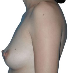Breast Reconstruction Before & After Patient #782