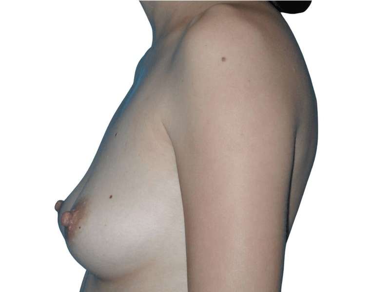 Breast Reconstruction Before & After Patient #782