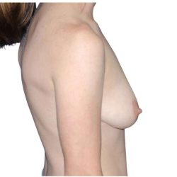 Breast Reconstruction Before & After Patient #794
