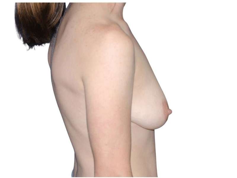 Breast Reconstruction Before & After Patient #794