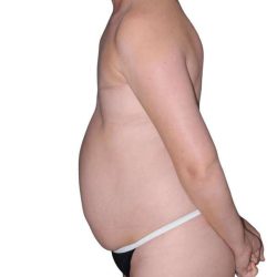 Breast Reconstruction Before & After Patient #805