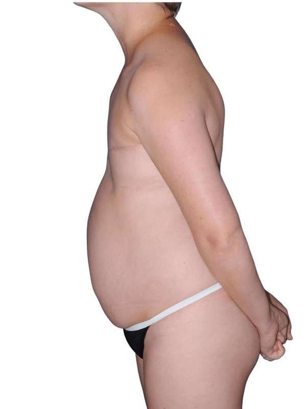 Breast Reconstruction Before & After Patient #805