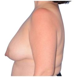 Breast Reconstruction Before & After Patient #828