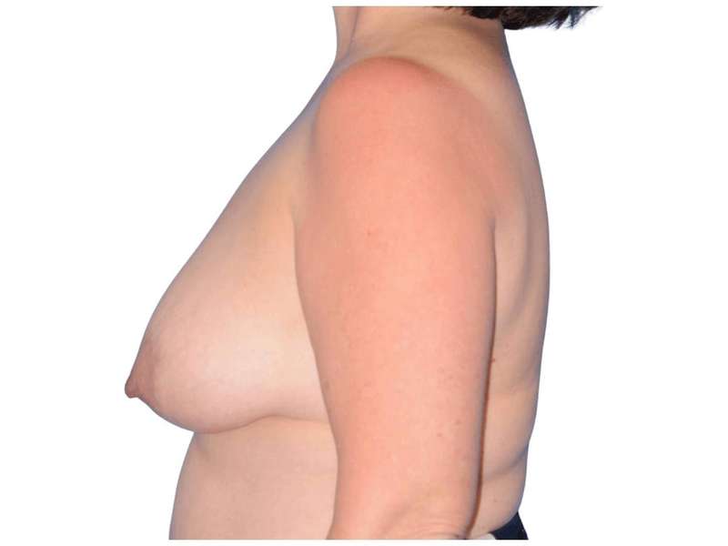 Breast Reconstruction Before & After Patient #828