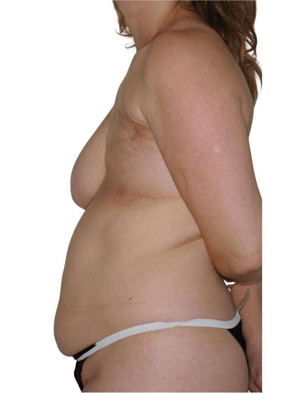 Breast Reconstruction Before & After Patient #837