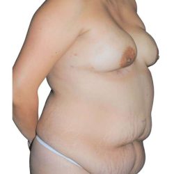 Breast Reconstruction Before & After Patient #873