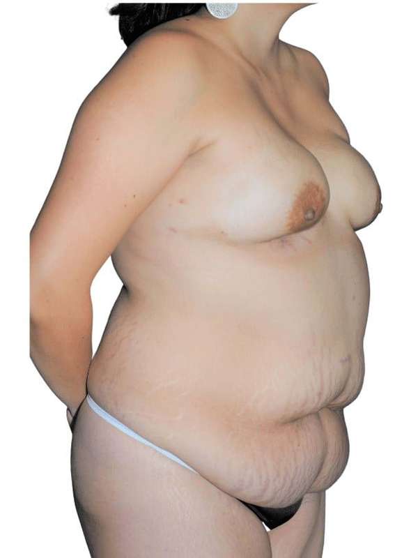 Breast Reconstruction Before & After Patient #873