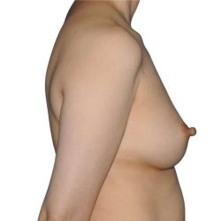 Breast Reconstruction Before & After Patient #880
