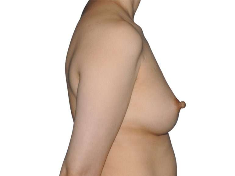 Breast Reconstruction Before & After Patient #880