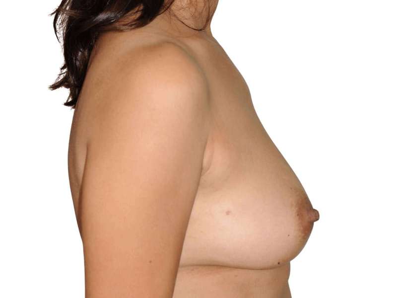Breast Reconstruction Before & After Patient #898