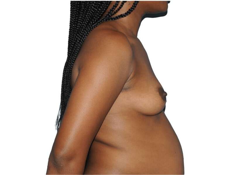 Breast Reconstruction Before & After Patient #905