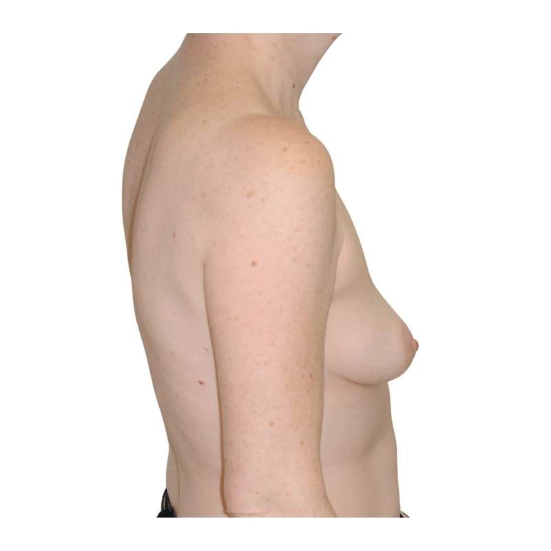Breast Reconstruction Before & After Patient #930