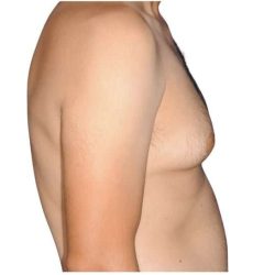 Gynecomastia Before & After Patient #515