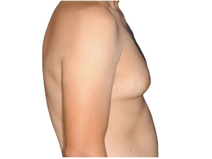 Gynecomastia Before & After Patient #515