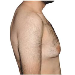 Gynecomastia Before & After Patient #525
