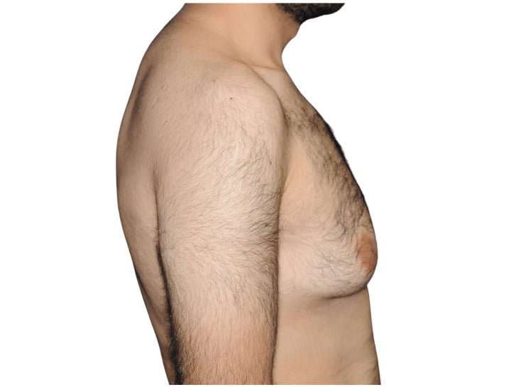 Gynecomastia Before & After Patient #525