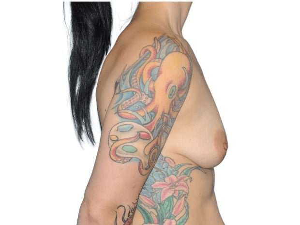 Breast Lift Before & After Patient #546