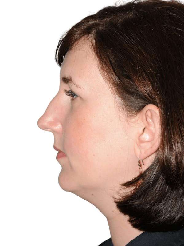 Rhinoplasty Before & After Patient #418