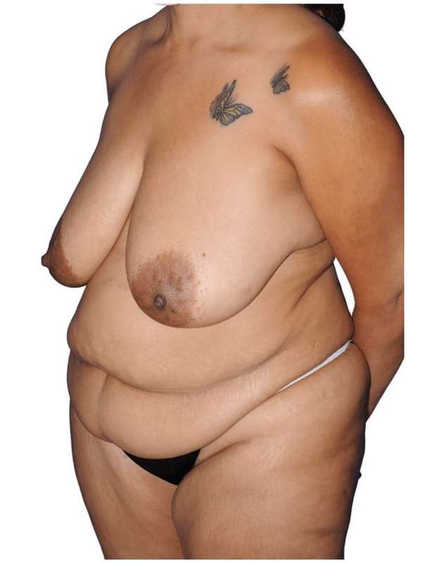 Tummy Tuck Before & After Patient #493
