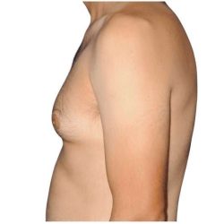 Gynecomastia Before & After Patient #515