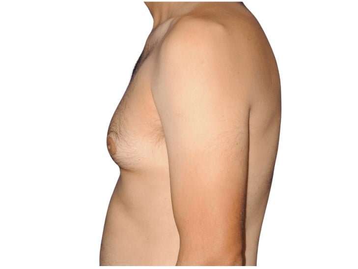 Gynecomastia Before & After Patient #515