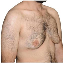 Gynecomastia Before & After Patient #525