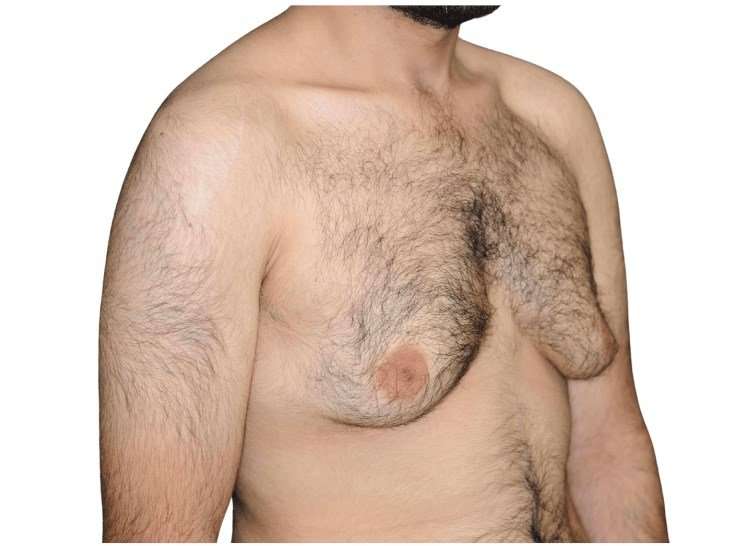 Gynecomastia Before & After Patient #525