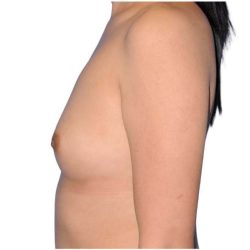 Breast Augmentation Before & After Patient #679