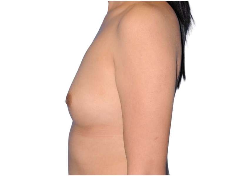 Breast Augmentation Before & After Patient #679
