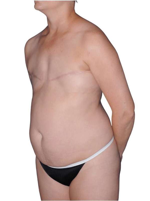 Breast Reconstruction Before & After Patient #805