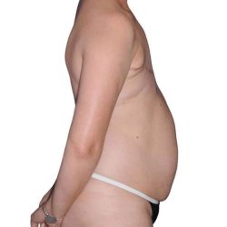 Breast Reconstruction Before & After Patient #805