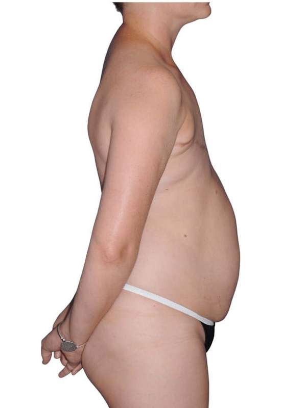 Breast Reconstruction Before & After Patient #805