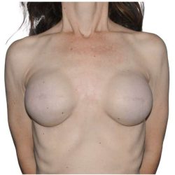 Breast Reconstruction Before & After Patient #821