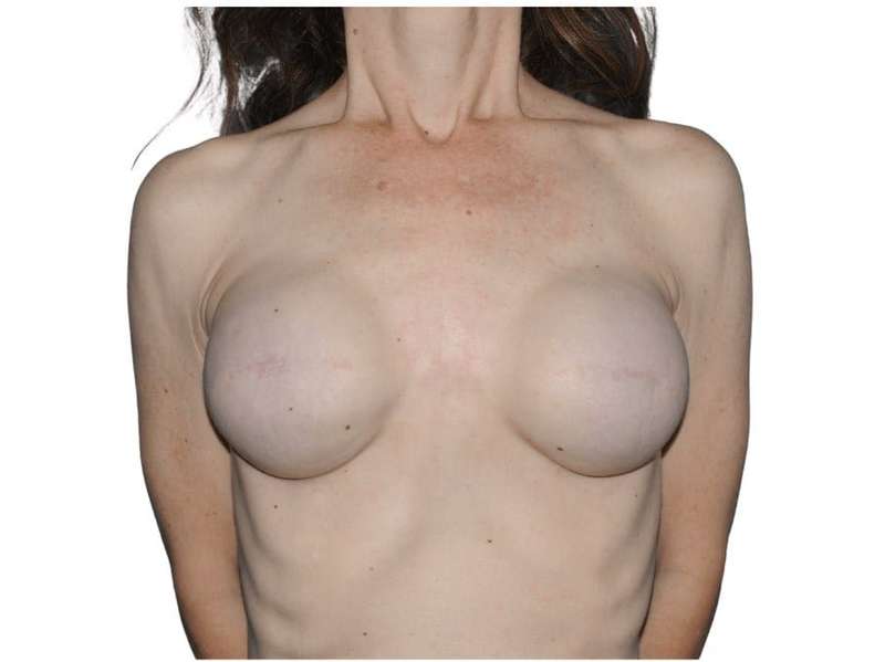 Breast Reconstruction Before & After Patient #821