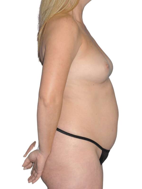 Breast Reconstruction Before & After Patient #923