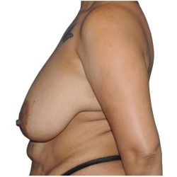 Tummy Tuck Before & After Patient #493